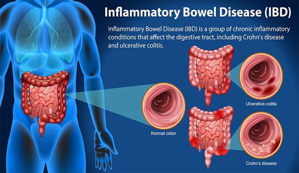 Inflammatory Bowel Disease